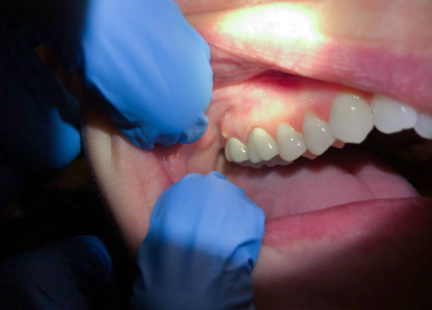 Best Emergency Gum Treatment in Willits, CA