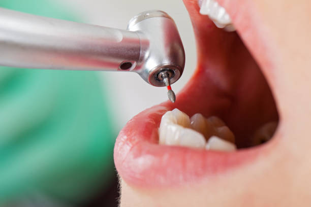Best Emergency Root Canal Treatment in Willits, CA